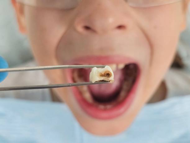 Best Emergency Root Canal Treatment in Osage City, KS